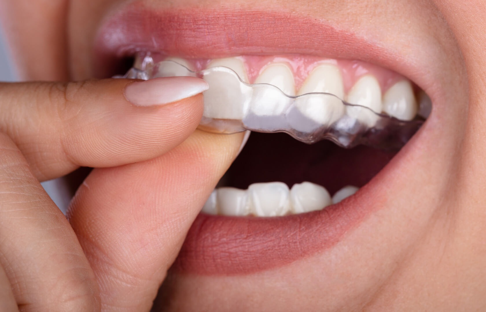 Eingesetzte transparente Aligner-Schiene